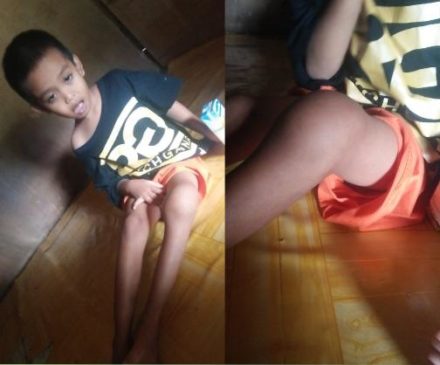 Diduga Idap Hemofilia, Anak Usia 7 Tahun di Mamuju Butuh Bantuan