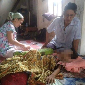 Bocah 4 Tahun di Ogan Ilir Idap Tumor Wajah Butuh Uluran Tangan