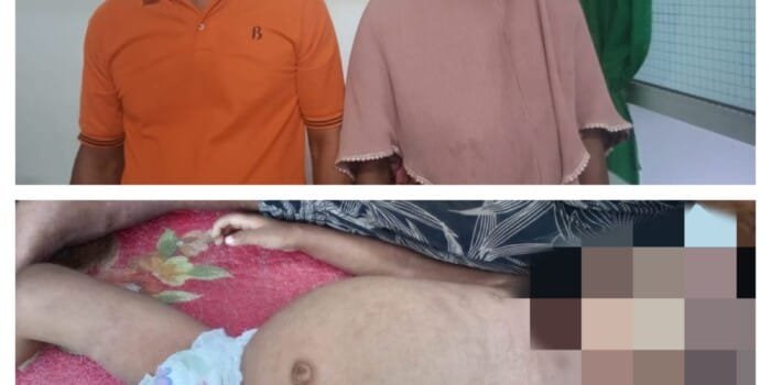 Meski Diduga Tidak Mendapat Perhatian Dari Pemkab Anak Penderita Gizi Buruk Berangsur Membaik.