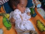 Alami Hidrosefalus, Bayi di Mamuju Butuh Uluran Tangan