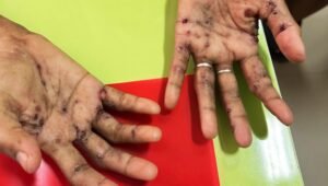 Warga 3-4 Ulu Suspect Cacar Monyet, Pasien Harus Isolasi Dua Minggu